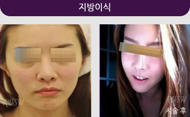 지방이식사진