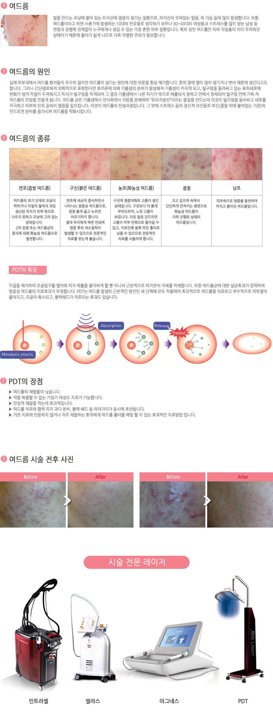 여드름이란 털을 만드는 모낭에 붙어 있는 피지선에 염증이 생기는 질환으로, 피지선이 모여 있는 얼굴이나 목 가슴 등에 많이 발생합니다. 보통 여드름이라고 하면 사춘기에 발생하는 10대의 전유무롤 생각하기 쉬우나 최근에는 성인 여드름등 2~40대의 여성들과 스트레스를 많이 받는 남성등 연령과 성별에 관계없이 누구에게나 생길 수 있는 가장 흔한 피부질환중 하나입니다. 사춘기 여드름과 달리 성인 여드름은 피부 각질층이 이미 두꺼워진 상태이기 때문에 흉터가 쉽게 나므로 더욱 각별한 주의가 필요합니다.