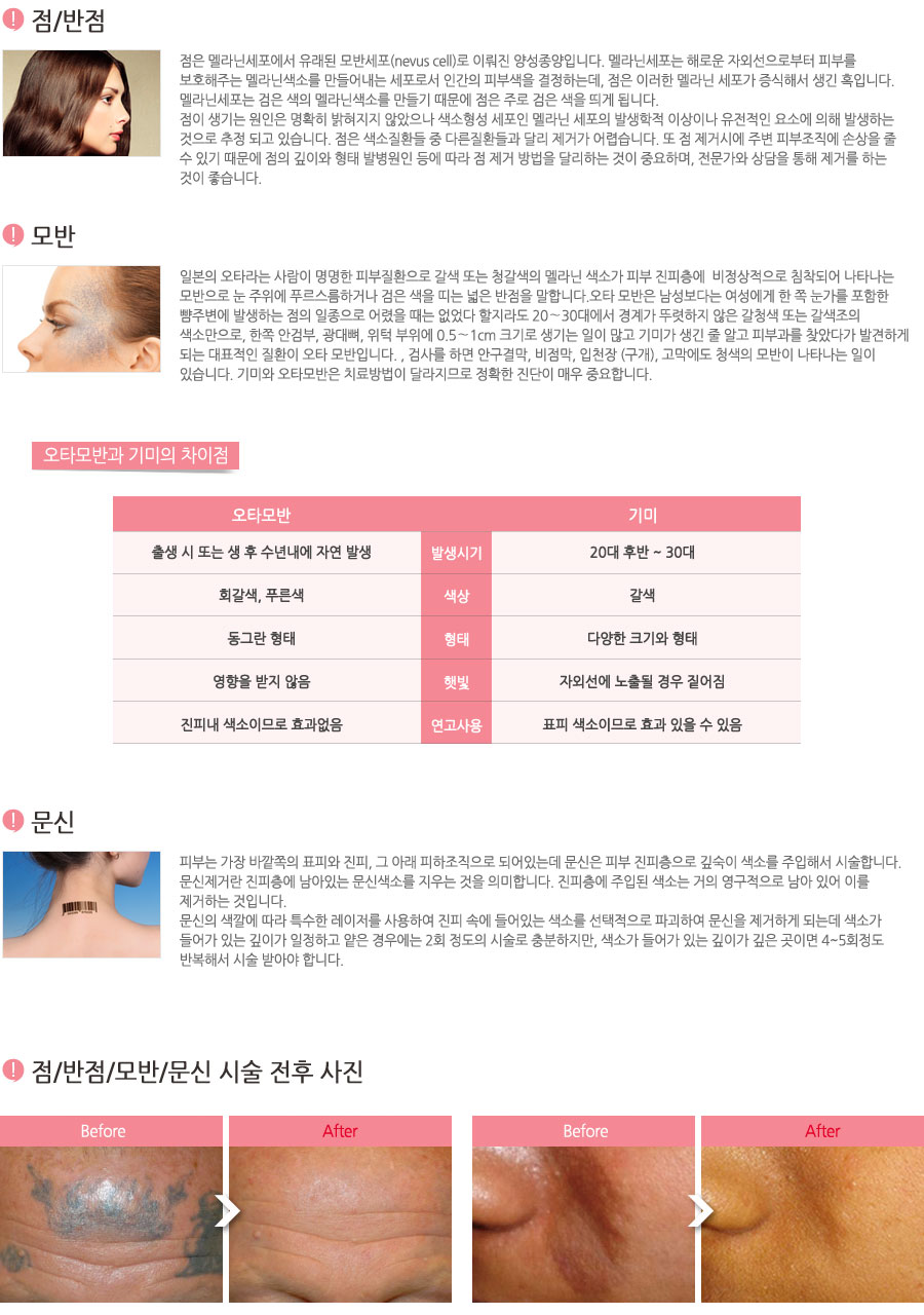 점은 멜라닌세포에서 유래된 모반세포(nevus cell)로 이뤄진 양성종양입니다. 멜라닌세포는 해로운 자외선으로부터 피부를 보호해주는 멜라닌색소를 만들어내는 세포로서 인간의 피부색을 결정하는데, 점은 이러한 멜라닌 세포가 증식해서 생긴 혹입니다. 멜라닌세포는 검은 색의 멜라닌색소를 만들기 때문에 점은 주로 검은 색을 띄게 됩니다. 점이 생기는 원인은 명확히 밝혀지지 않았으나 색소형성 세포인 멜라닌 세포의 발생학적 이상이나 유전적인 요소에 의해 발생하는 것으로 추정 되고 있습니다. 점은 색소질환들 중 다른질환들과 달리 제거가 어렵습니다. 또 점 제거시에 주변 피부조직에 손상을 줄 수 있기 때문에 점의 깊이와 형태 발병원인 등에 따라 점 제거 방법을 달리하는 것이 중요하며, 전문가와 상담을 통해 제거를 하는 것이 좋습니다.